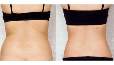 五月腰部吸脂 夏天小蛮腰