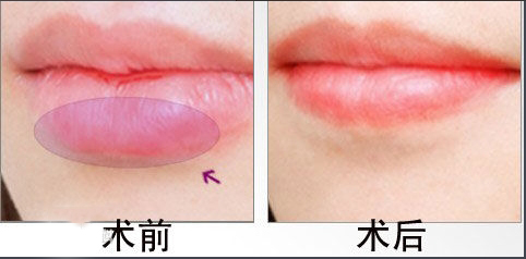 玻尿酸丰唇的优点