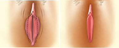 阴唇肥大怎么办?