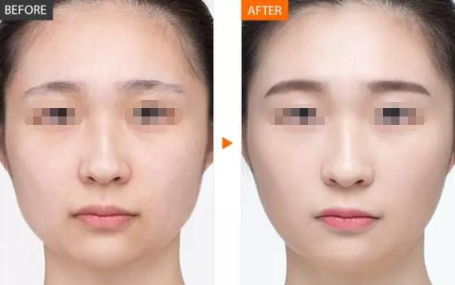 玻尿酸是什么?玻尿酸有什么用?