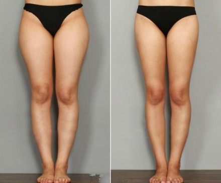 腿部吸脂容易反弹吗?