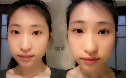 割双眼皮选哪种方法好