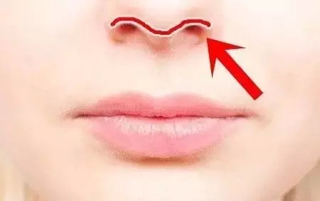 鼻尖整形要注意的问题有哪些?